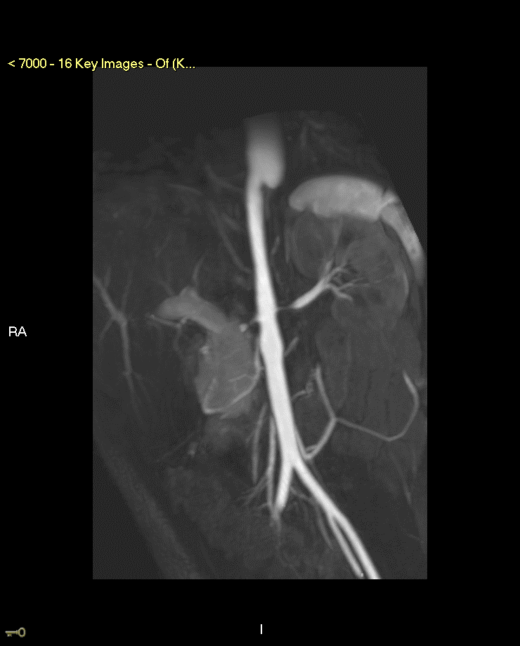 MR-angiography of the abdomen showed perivascular wall enhancement of the proximal abdominal aorta and critical narrowing of renal arteries.